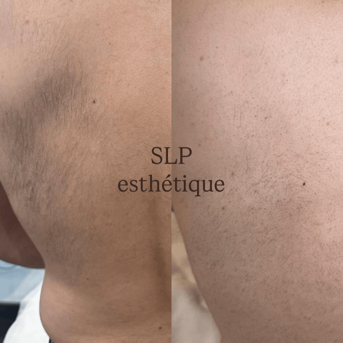Épilation laser Boisbriand — Sous La Peau